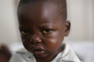 Three-year-old Jonathan Kangu sits on his hospital bed in Kinshasa, Congo, on Tuesday, July 19, 2016, suffering from symptoms of yellow fever, including yellowed eyes. Because of a shortage of diagnostic materials, doctors were not able to confirm whether or not he has yellow fever, as the symptoms are similar to those for many other diseases in the region. Jonathan ultimately recovered and was discharged, but without knowing for sure whether he had yellow fever, it was unclear if his family should be prioritized to receive the vaccine. (Jerome Delay/Associated Press)